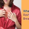 Rash Between Breast