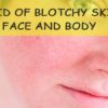 Blotchy Skin